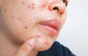 Papular acne treatment